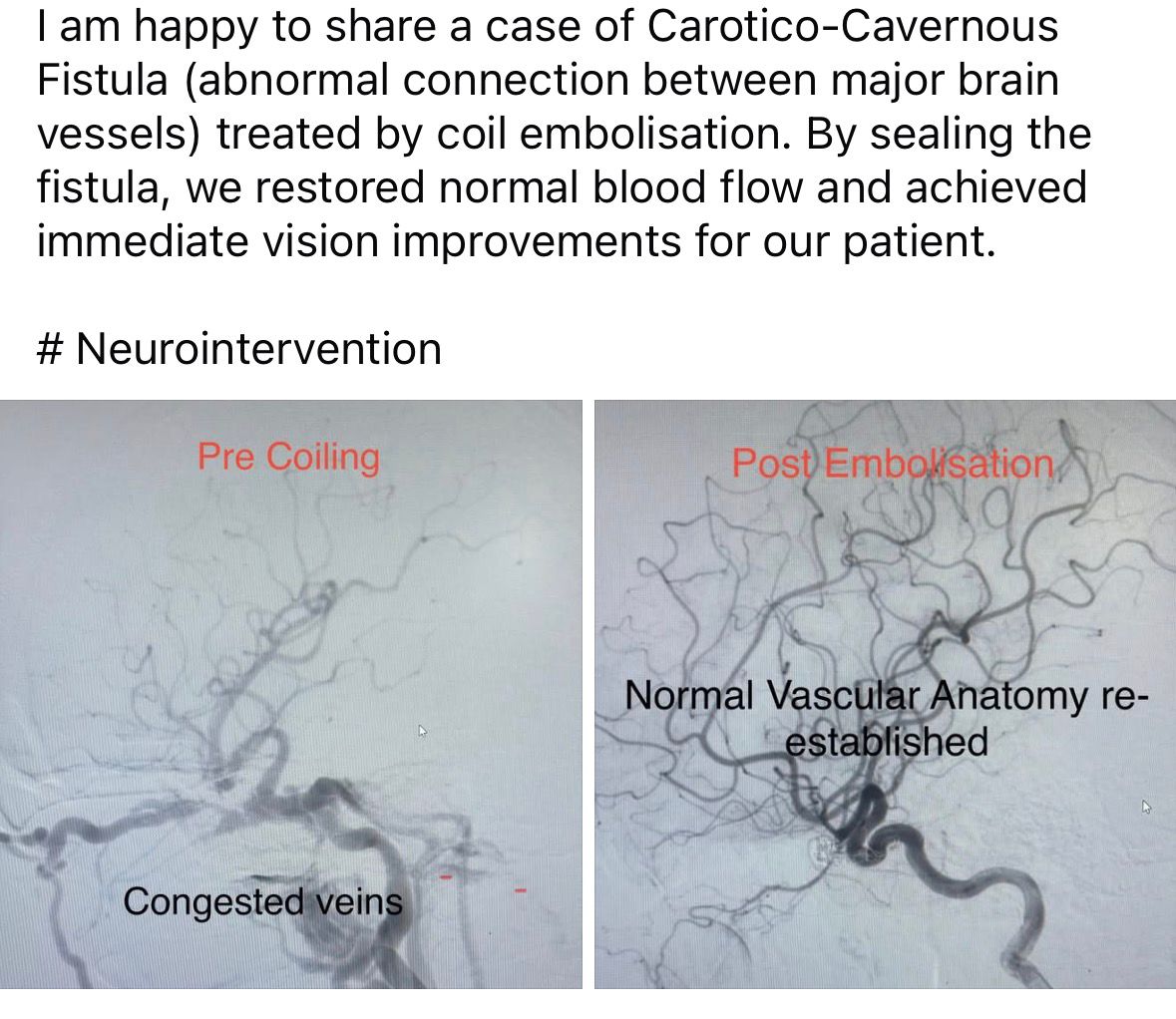 Carotico-Cavernous Fistula Treatment in Bhubaneswar – Successful Coil Embolisation